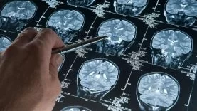 Alzheimer Tehlikesini Artıran Genetik Değişkenlik Keşfedildi