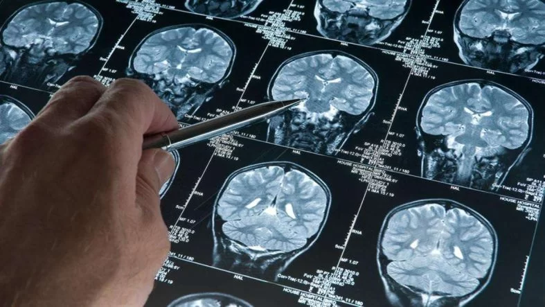 Alzheimer Tehlikesini Artıran Genetik Değişkenlik Keşfedildi